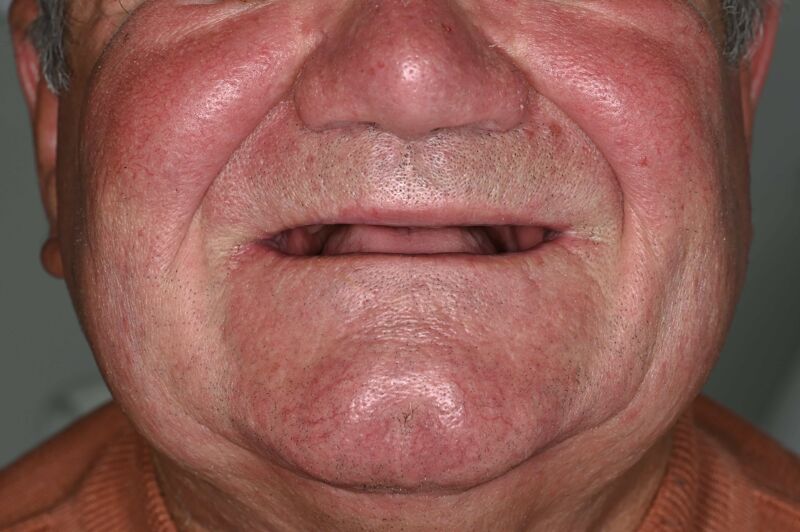 Zâmbet lateral stanga_înainte